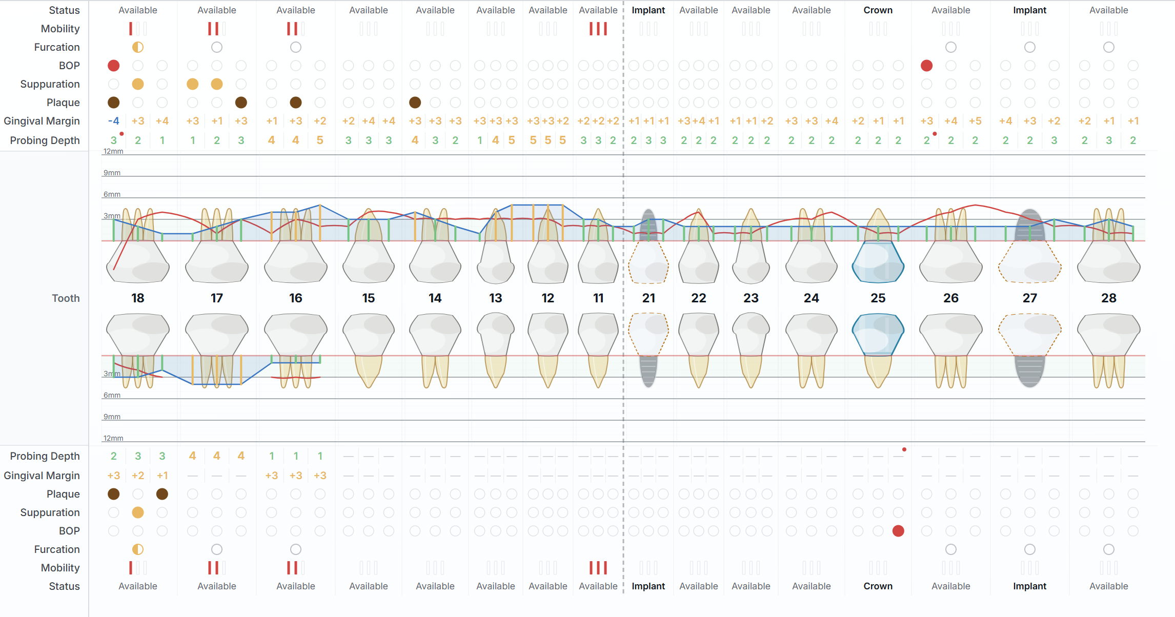 ToothTale periodontal (BPE) chart with probing depths, bleeding and plaque per tooth